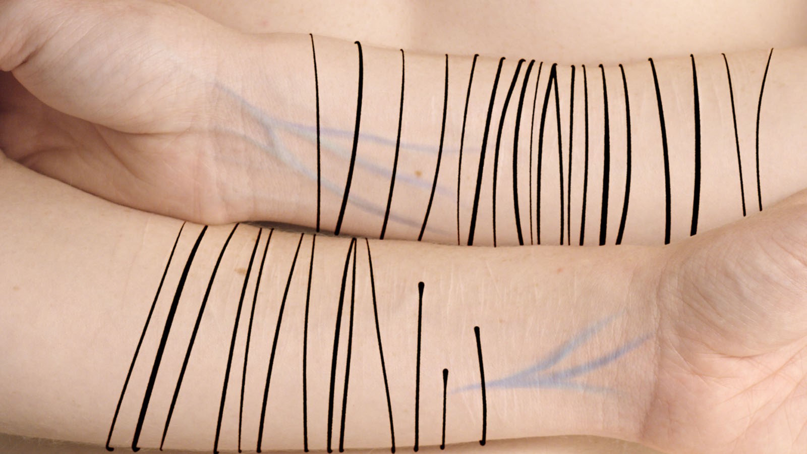 Scars